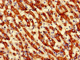 ECH1 Antibody - Immunohistochemistry image of paraffin-embedded human liver cancer at a dilution of 1:100