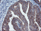 ECI2 / PECI Antibody - IHC of paraffin-embedded Adenocarcinoma of Human endometrium tissue using anti-PECI mouse monoclonal antibody. (Heat-induced epitope retrieval by 10mM citric buffer, pH6.0, 100C for 10min).
