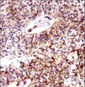 ECT2 Antibody - ECT2 Antibody immunohistochemistry of formalin-fixed and paraffin-embedded human lung squamous carcinoma followed by peroxidase-conjugated secondary antibody and DAB staining.
