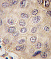 EDA / Ectodysplasin A Antibody - Formalin-fixed and paraffin-embedded human hepatocarcinoma tissue reacted with EDA antibody , which was peroxidase-conjugated to the secondary antibody, followed by DAB staining. This data demonstrates the use of this antibody for immunohistochemistry; clinical relevance has not been evaluated.