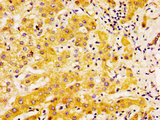 EDAR Antibody - Immunohistochemistry image at a dilution of 1:500 and staining in paraffin-embedded human liver cancer performed on a Leica BondTM system. After dewaxing and hydration, antigen retrieval was mediated by high pressure in a citrate buffer (pH 6.0) . Section was blocked with 10% normal goat serum 30min at RT. Then primary antibody (1% BSA) was incubated at 4 °C overnight. The primary is detected by a biotinylated secondary antibody and visualized using an HRP conjugated SP system.