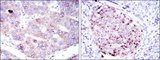 EEF2 / Elongation Factor 2 Antibody - IHC of paraffin-embedded liver cancer tissues (left) and kidney cancer tissues (right) using EEF2 mouse mAb with DAB staining.
