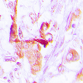EEF2 / Elongation Factor 2 Antibody - Immunohistochemical analysis of EEF2 staining in human lung cancer formalin fixed paraffin embedded tissue section. The section was pre-treated using heat mediated antigen retrieval with sodium citrate buffer (pH 6.0). The section was then incubated with the antibody at room temperature and detected using an HRP conjugated compact polymer system. DAB was used as the chromogen. The section was then counterstained with hematoxylin and mounted with DPX.