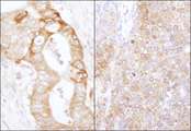 EEF2K Antibody - Detection of Human and Mouse eEF2 Kinase by Immunohistochemistry. Sample: FFPE section of human stomach carcinoma (left) and mouse teratoma (right). Antibody: Affinity purified rabbit anti-eEF2 Kinase used at a dilution of 1:1000 (1 Detection: DAB.