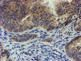 EEYORE / TIGD1 Antibody - IHC of paraffin-embedded Adenocarcinoma of Human endometrium tissue using anti-TIGD1 mouse monoclonal antibody. (Heat-induced epitope retrieval by 10mM citric buffer, pH6.0, 100C for 10min).