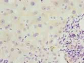 EFCAB12 / C3orf25 Antibody - Immunohistochemistry of paraffin-embedded human liver cancer using antibody at dilution of 1:100.