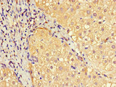 EFCAB7 Antibody - Immunohistochemistry of paraffin-embedded human liver cancer at dilution 1:100