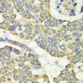 EFTU / TUFM Antibody - Immunohistochemistry of paraffin-embedded human esophageal cancer tissue.