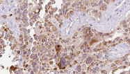 EGFL7 Antibody - 1:100 staining human Melanoma tissue by IHC-P. The sample was formaldehyde fixed and a heat mediated antigen retrieval step in citrate buffer was performed. The sample was then blocked and incubated with the antibody for 1.5 hours at 22°C. An HRP conjugated goat anti-rabbit antibody was used as the secondary.