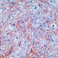 EGFR Antibody - Formalin-fixed, paraffin-embedded human squamous cell carcinoma of lung stained with peroxidase-conjugate and AEC chromogen. Note cell membrane staining of tumor cells. This image was taken for the unmodified form of this product. Other forms have not been tested.