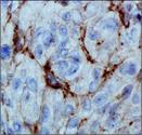 EGLN3 / PHD3 Antibody - HIF Prolyl Hydroxylase 3 Antibody (EG188e/d5) - IHC of HIF Prolyl Hydroxylase 3 in human renal cancer using DAB with hematoxylin counterstain.  This image was taken for the unconjugated form of this product. Other forms have not been tested.