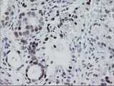 EGR2 Antibody - IHC of paraffin-embedded Adenocarcinoma of Human ovary tissue using anti-EGR2 mouse monoclonal antibody.