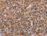 EGR4 / EGR-4 Antibody - Immunohistochemistry of paraffin-embedded Human liver cancer using EGR4 Polyclonal Antibody at dilution of 1:20.