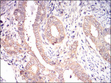 EIF2A / EIF2 Alpha Antibody - IHC of paraffin-embedded cervical cancer tissues using EIF2A mouse monoclonal antibody with DAB staining.