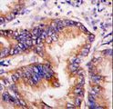 EIF2AK1 Antibody - Formalin-fixed and paraffin-embedded human lung carcinoma tissue reacted with EIF2AK1 antibody , which was peroxidase-conjugated to the secondary antibody, followed by DAB staining. This data demonstrates the use of this antibody for immunohistochemistry; clinical relevance has not been evaluated.