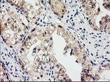EIF4E2 / IF4e Antibody - IHC of paraffin-embedded Adenocarcinoma of Human ovary tissue using anti-EIF4E2 mouse monoclonal antibody. (Heat-induced epitope retrieval by 10mM citric buffer, pH6.0, 100C for 10min).