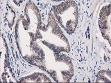EIF4E2 / IF4e Antibody - IHC of paraffin-embedded Carcinoma of Human prostate tissue using anti-EIF4E2 mouse monoclonal antibody.