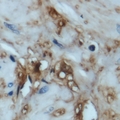 EIF4EBP1 / 4EBP1 Antibody - Immunohistochemical analysis of 4EBP1 staining in human prostate cancer formalin fixed paraffin embedded tissue section. The section was pre-treated using heat mediated antigen retrieval with sodium citrate buffer (pH 6.0). The section was then incubated with the antibody at room temperature and detected using an HRP polymer system. DAB was used as the chromogen. The section was then counterstained with hematoxylin and mounted with DPX.