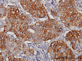 EIF4G3 Antibody - Immunoperoxidase of monoclonal antibody to EIF4G3 on formalin-fixed paraffin-embedded human lung, adenosquamous cell carcinoma. [antibody concentration 3 ug/ml].