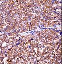 EIF5A2 Antibody - EIF5A2 Antibody immunohistochemistry of formalin-fixed and paraffin-embedded human ovarian carcinoma followed by peroxidase-conjugated secondary antibody and DAB staining.
