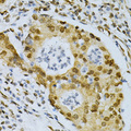 ELAVL1 / HUR Antibody - Immunohistochemistry of paraffin-embedded human gastric cancer using ELAVL1 Antibodyat dilution of 1:200 (40x lens).