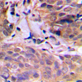 ELAVL2 / HUB Antibody - Immunohistochemical analysis of HuB staining in human breast cancer formalin fixed paraffin embedded tissue section. The section was pre-treated using heat mediated antigen retrieval with sodium citrate buffer (pH 6.0). The section was then incubated with the antibody at room temperature and detected using an HRP conjugated compact polymer system. DAB was used as the chromogen. The section was then counterstained with hematoxylin and mounted with DPX.