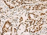 ELF5 Antibody - Immunohistochemistry of paraffin-embedded Human cervical cancer tissue  using ELF5 Polyclonal Antibody at dilution of 1:70(×200)