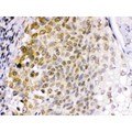 EME1 Antibody - EME1 antibody IHC-paraffin. IHC(P): Human Lung Cancer Tissue.