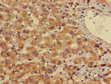 EN2 Antibody - Immunohistochemistry of paraffin-embedded human liver cancer using EN2 Antibody at dilution of 1:100