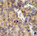 Endostatin Antibody - COL18A1 Antibody immunohistochemistry of formalin-fixed and paraffin-embedded human hepatocarcinoma followed by peroxidase-conjugated secondary antibody and DAB staining.