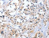 Endothelin 3 / EDN3 Antibody - Immunohistochemistry of paraffin-embedded Human thyroid cancer using EDN3 Polyclonal Antibody at dilution of 1:30.
