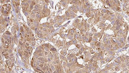 Endothelin 3 / EDN3 Antibody - 1:100 staining human Melanoma tissue by IHC-P. The sample was formaldehyde fixed and a heat mediated antigen retrieval step in citrate buffer was performed. The sample was then blocked and incubated with the antibody for 1.5 hours at 22°C. An HRP conjugated goat anti-rabbit antibody was used as the secondary.