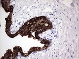 ENKUR Antibody - IHC of paraffin-embedded Carcinoma of Human prostate tissue using anti-ENKUR mouse monoclonal antibody. (Heat-induced epitope retrieval by 1 mM EDTA in 10mM Tris, pH8.5, 120°C for 3min).