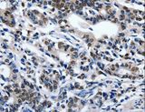 ENPP3 / CD203c Antibody - Immunohistochemistry of paraffin-embedded Human gastric cancer using ENPP3 Polyclonal Antibody at dilution of 1:80.