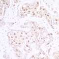EP300 / p300 Antibody - Detection of human p300 by immunohistochemistry. Sample: FFPE section of human lung carcinoma. Antibody: Affinity purified rabbit anti-p300 used at a dilution of 1:1,000 (1µg/ml). Detection: DAB.