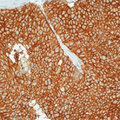 EPCAM Antibody - Formalin-fixed, paraffin-embedded human breast cancer stained with peroxidase-conjugate and DAB chromogen. Note cell membrane staining of tumor cells.  This image was taken for the unmodified form of this product. Other forms have not been tested.