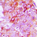 EPH Receptor B1+B2 Antibody - Immunohistochemical analysis of EPHB1/2 staining in human breast cancer formalin fixed paraffin embedded tissue section. The section was pre-treated using heat mediated antigen retrieval with sodium citrate buffer (pH 6.0). The section was then incubated with the antibody at room temperature and detected using an HRP polymer system. DAB was used as the chromogen. The section was then counterstained with hematoxylin and mounted with DPX.