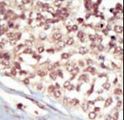 EPHA5 / EPH Receptor A5 Antibody - Formalin-fixed and paraffin-embedded human cancer tissue reacted with the primary antibody, which was peroxidase-conjugated to the secondary antibody, followed by AEC staining. This data demonstrates the use of this antibody for immunohistochemistry; clinical relevance has not been evaluated. BC = breast carcinoma; HC = hepatocarcinoma.