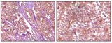 EPHB4 / EPH Receptor B4 Antibody - IHC of paraffin-embedded Human pancreas carcinoma (left) and breast carcinoma (right) tissue, showing membrane and cytoplasmic (pancreas carcinoma) localization, membrane (breast carcinoma) localization using EphB4 mouse