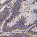 EPHX2 / Epoxide Hydrolase 2 Antibody - Immunohistochemistry of paraffin-embedded human rectum cancer tissue.