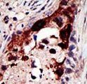 EPN2 Antibody - Formalin-fixed and paraffin-embedded human cancer tissue reacted with the primary antibody, which was peroxidase-conjugated to the secondary antibody, followed by AEC staining. This data demonstrates the use of this antibody for immunohistochemistry; clinical relevance has not been evaluated. BC = breast carcinoma; HC = hepatocarcinoma.