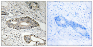 EPN3 Antibody - Immunohistochemistry analysis of paraffin-embedded human colon carcinoma tissue, using EPN3 Antibody. The picture on the right is blocked with the synthesized peptide.