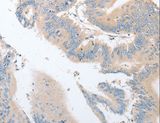 EPS15L1 / EPS15R Antibody - Immunohistochemistry of paraffin-embedded Human colon cancer using EPS15L1 Polyclonal Antibody at dilution of 1:30.