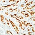 ER Alpha / Estrogen Receptor Antibody - Formalin-fixed, paraffin-embedded human breast carcinoma stained with peroxidase-conjugate and DAB chromogen. Note nuclear staining of tumor cells.