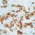 ER Alpha / Estrogen Receptor Antibody - Formalin-fixed, paraffin-embedded human breast carcinoma stained with peroxidase-conjugate and DAB chromogen. Note intense nuclear staining of tumor cells.  This image was taken for the unmodified form of this product. Other forms have not been tested.