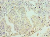 ERCC2 / XPD Antibody - Immunohistochemistry of paraffin-embedded human lung cancer using antibody at 1:100 dilution.