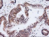 ERCC4 / XPF Antibody - IHC of paraffin-embedded Adenocarcinoma of Human colon tissue using anti-ERCC4 mouse monoclonal antibody.
