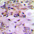 ERCC5 / XPG Antibody - Immunohistochemical analysis of ERCC5 staining in human breast cancer formalin fixed paraffin embedded tissue section. The section was pre-treated using heat mediated antigen retrieval with sodium citrate buffer (pH 6.0). The section was then incubated with the antibody at room temperature and detected using an HRP conjugated compact polymer system. DAB was used as the chromogen. The section was then counterstained with hematoxylin and mounted with DPX.