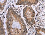 ERCC6L / FLJ20105 Antibody - Immunohistochemistry of paraffin-embedded Human colon cancer using ERCC6L Polyclonal Antibody at dilution of 1:30.