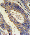 EREG / Epiregulin Antibody - EREG Antibody IHC of formalin-fixed and paraffin-embedded colon carcinoma followed by peroxidase-conjugated secondary antibody and DAB staining.